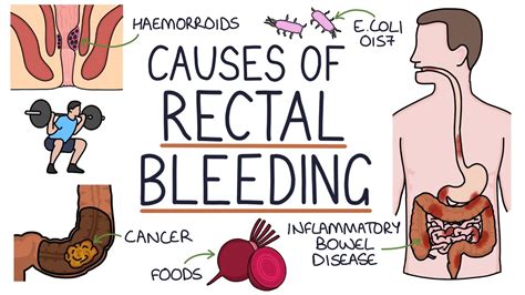 blood in stool after anal sex